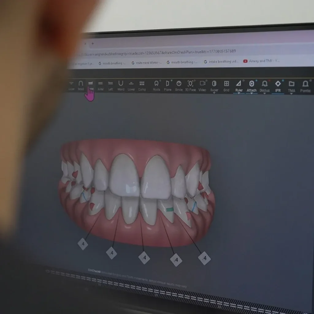 clear aligners in Dubai