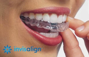 invisalign