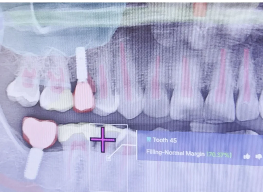 Invisalign vs Braces