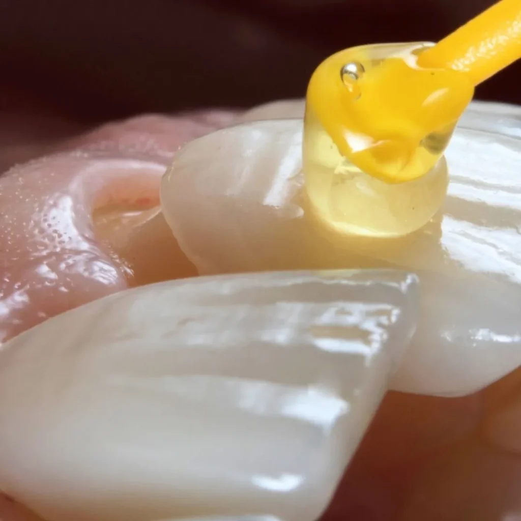 dental veneers in Dubai