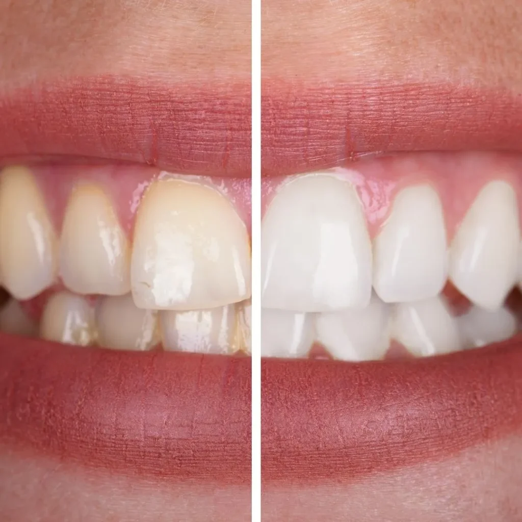 teeth cleaning in Dubai
